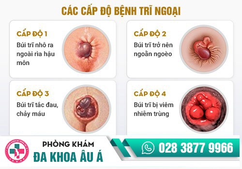 NHỮNG BIỂU HIỆN BỆNH TRĨ NGOẠI?