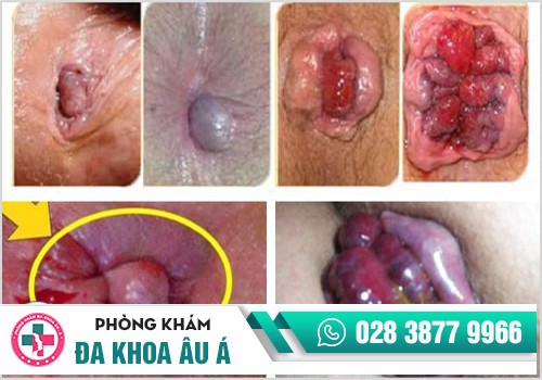 Hình ảnh lòi búi trĩ 