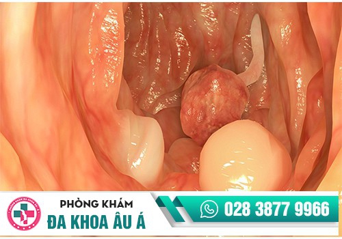 Hình ảnh Polyp hậu môn