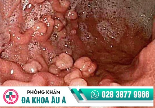 POLYP HẬU MÔN LÀ BỆNH GÌ?