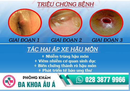 Những nguyên nhận phổ biến dẫn đến áp xe hậu môn