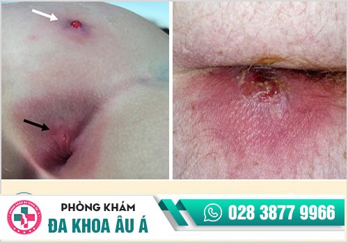 Triệu chứng thường gặp khi bị áp xe hậu môn