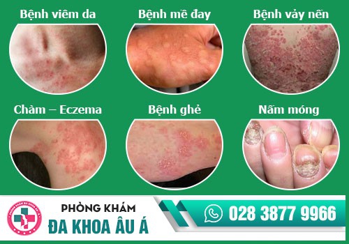 bệnh da liễu thường gặp