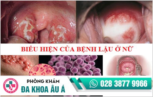 Tìm hiểu về các giai đoạn của bệnh lậu