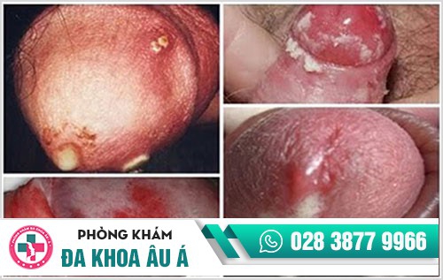 Bệnh lậu nam có thể gây vô sinh và nguy cơ tử vong cao