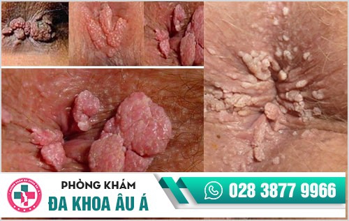 Sùi mào gà