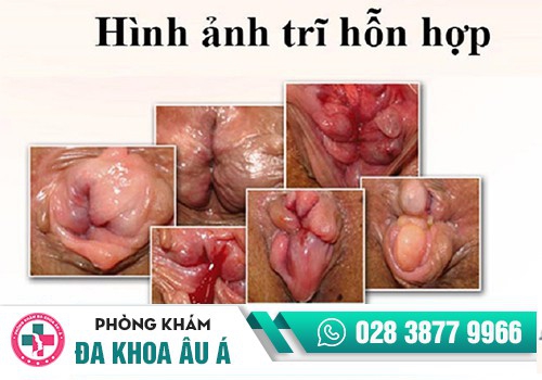 Trĩ hỗn hợp 