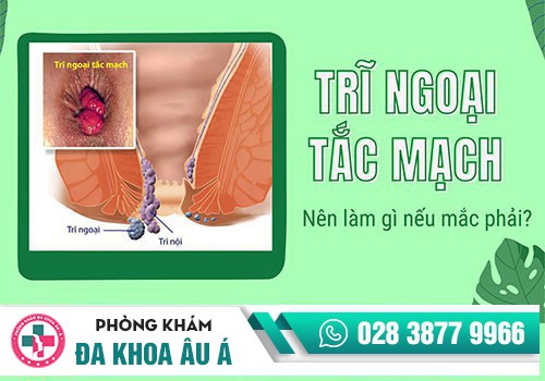 Triệu chứng của trĩ tắc mạch 