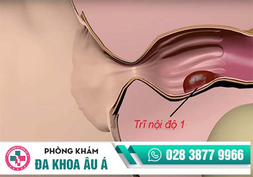 Hình ảnh bệnh trĩ nội