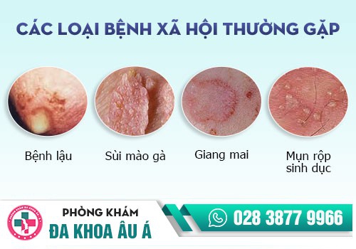 bệnh xã hội thường gặp