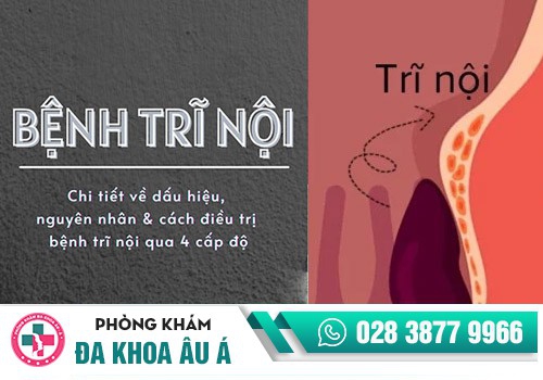 NGUYÊN NHÂN VÀ TÁC HẠI CỦA BỆNH TRĨ NỘI