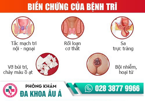CẢNH BÁO BIẾN CHỨNG TRĨ NGOẠI ĐỘ 1, ĐỘ 2