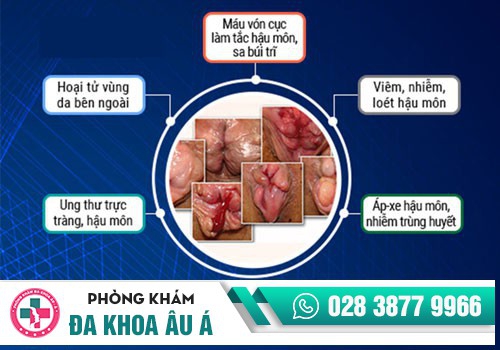 NHỮNG BIẾN CHỨNG NGUY HIỂM CỦA BỆNH TRĨ NỘI