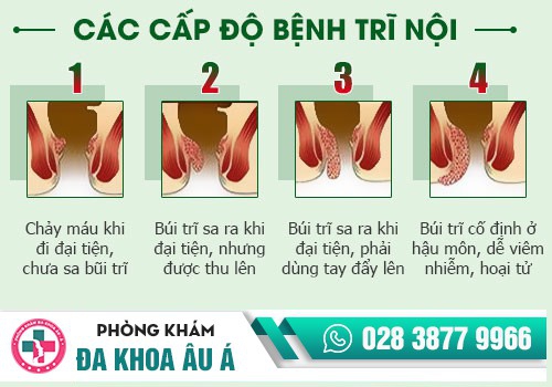 NHỮNG PHƯƠNG PHÁP HỖ TRỢ ĐIỀU TRỊ BỆNH TRĨ NỘI HIỆU QUẢ