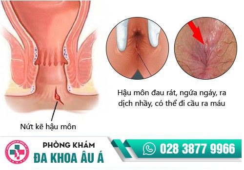 Nguyên nhân nào khiến bạn bị nứt kẽ hậu môn?