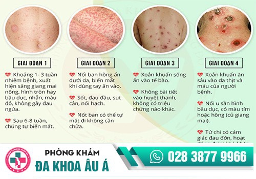Bệnh giang mai nguy hiểm như thế nào, điều trị ra sao?