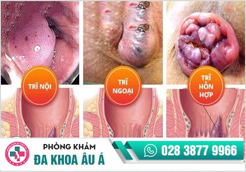 Các dạng bệnh trĩ hiện nay