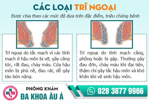 NHẬN BIẾT CÁC BIỂU HIỆN CỦA BỆNH TRĨ NGOẠI ĐỘ 1, ĐỘ 2