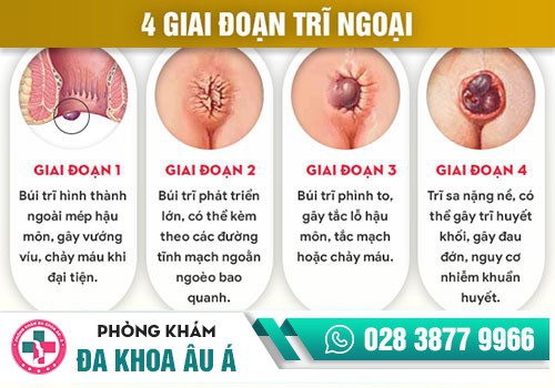 SỰ KHÁC NHAU GIỮA TRĨ NỘI TRĨ NGOẠI