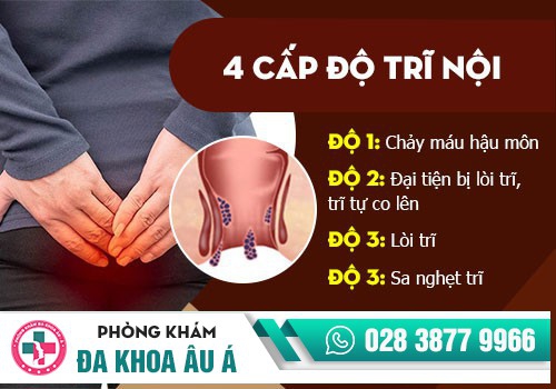 cấp độ bệnh trĩ nội