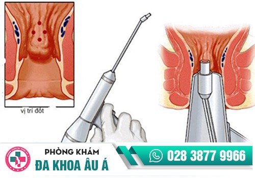 4 phương pháp cắt trĩ phố biến hiện nay