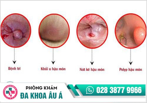 Chảy máu hậu môn là dấu hiệu bệnh lý hậu môn - trực tràng