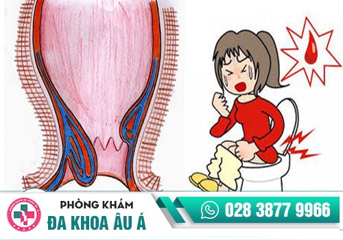 ĐI CẦU RA MÁU LÀ DẤU HIỆU BỆNH TRĨ