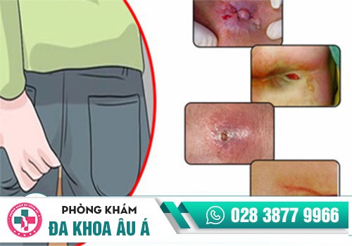 Hậu môn tiết chất nhầy