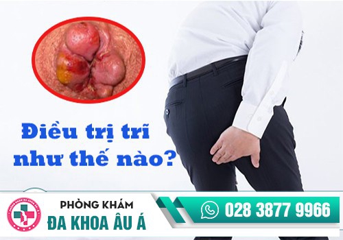 ĐIỀU TRỊ BỆNH TRĨ NHƯ THẾ NÀO?