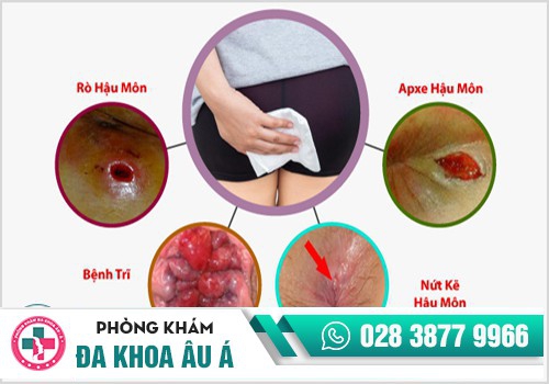 Hậu môn chảy mủ là mắc bệnh lý gì?