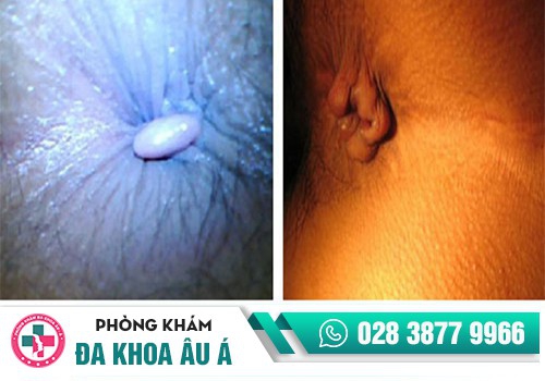 Nguyên nhân hình thành trĩ ngoại