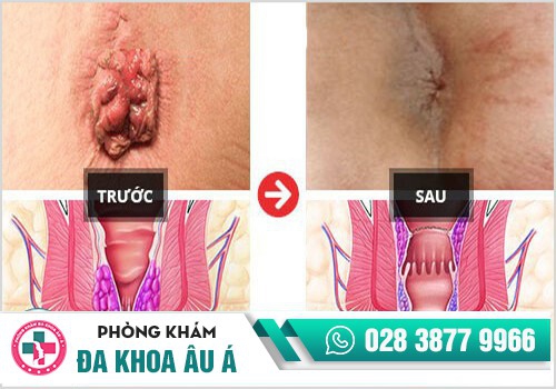 Phương pháp HCPT