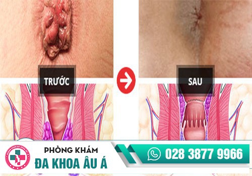 Kết quả cắt trĩ