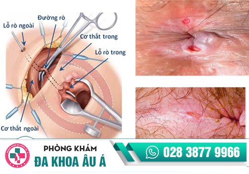 biến chứng rò hậu môn