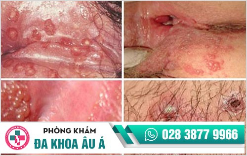 Tổng quan về mụn rộp sinh dục