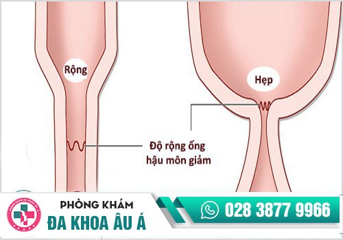  HẸP HẬU MÔN