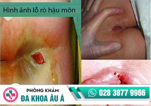 Bệnh rò hậu môn có tự khỏi được không?