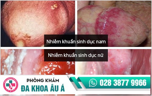 Dấu hiệu nhận biết nhiễm khuẩn sinh dục và cách điều trị hiệu quả