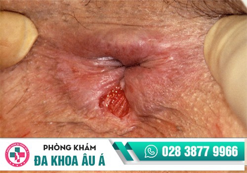 Nứt da xung quanh hậu môn