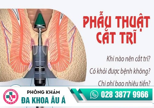 Có nên làm phẫu thuật cắt trĩ không?