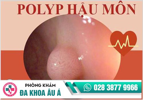 DẤU HIỆU CỦA POLYP HẬU MÔN