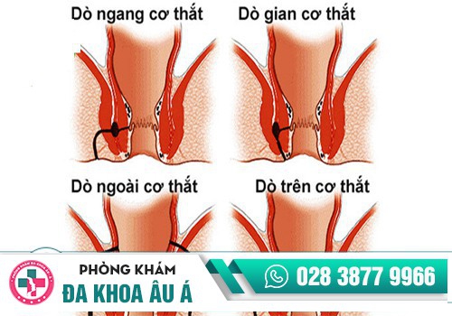Các dạng rò hậu môn phổ biến