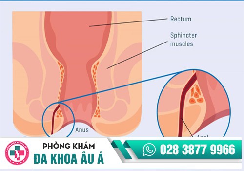 Bệnh rò hậu môn 