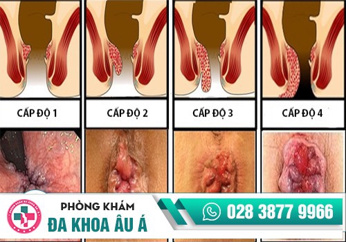 Các cấp độ sa búi trĩ
