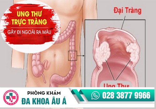 ung thư đại tràng