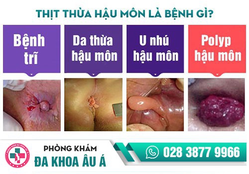 NỔI CỤC THỊT THỪA GẦN HẬU MÔN LÀ TRIỆU CHỨNG BỆNH GÌ?