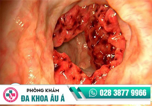 Hình ảnh ung thư trực tràng