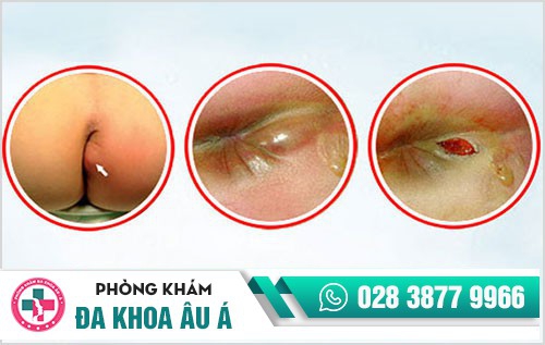 Bệnh trĩ nên được khám và điều trị tại cơ sở y tế chuyên khoa