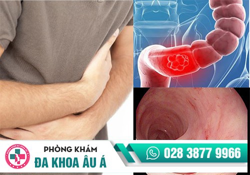 Vết loét trong đại trực tràng