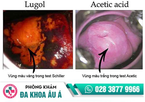 Xét nghiệm sùi mào gà bằng phương pháp Acid acetic